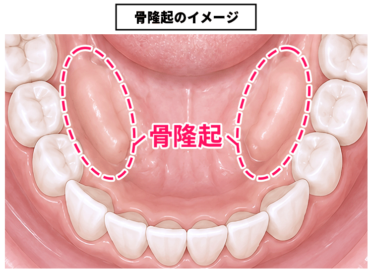 歯を守るために知っておきたい ブラキシズム